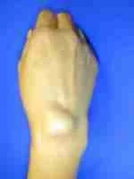 Excision Dorsal Wrist ganglion