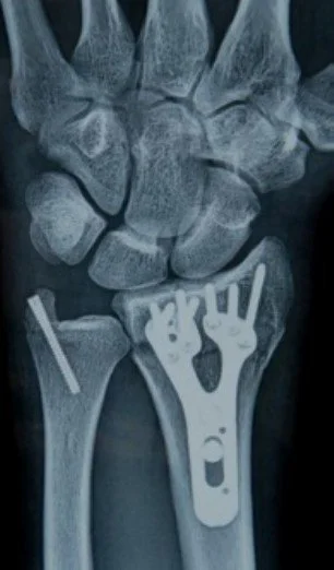 Colles Fracture Plating