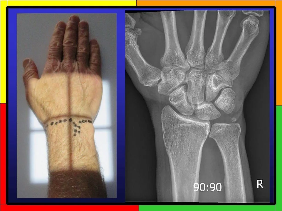 Wrist Instability Views ( WIV)