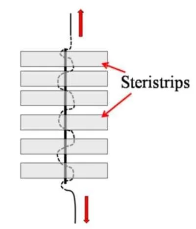 Wounds closed with Monocrul