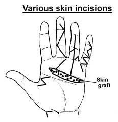 Fasciectomy ( Shark Attack)