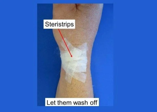 De Quervains - Post op