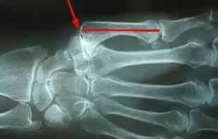 Basal Thumb Joint