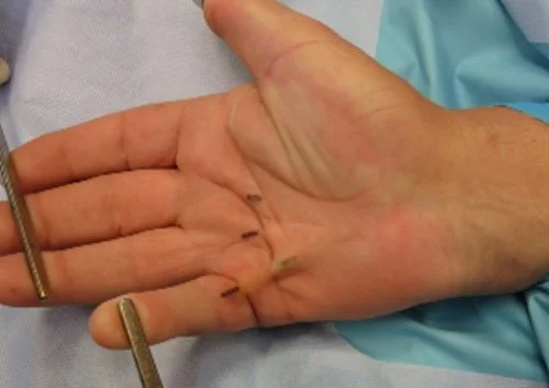 Dupuytrens - Percutaneous Fasciotomy