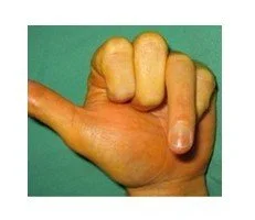 Flexor Tendon Injuries