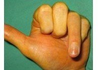 Flexor tendon repair