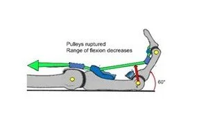 Flexor Pulley Injuries