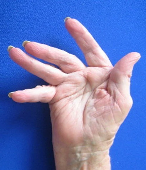 Rheumatoid Arthiris