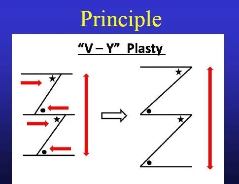 Dupuytrens - V - Y Plasty