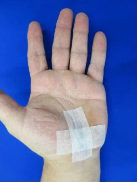 Post Removal Sutures