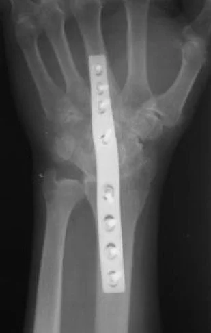Wrist Arthritis - Salvage Procedures