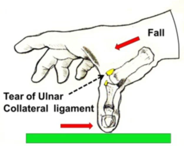 Skiers Thumb Mechanism of Injury
