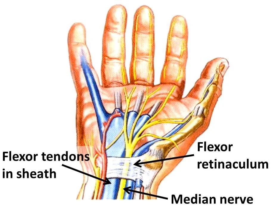 Carpal Tunnel Syndrome