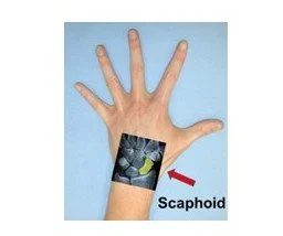 Scaphoid Fractures