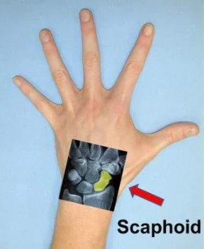 Scaphoid Fractures