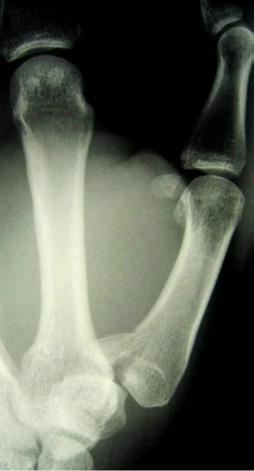 Bennetts Fracture
