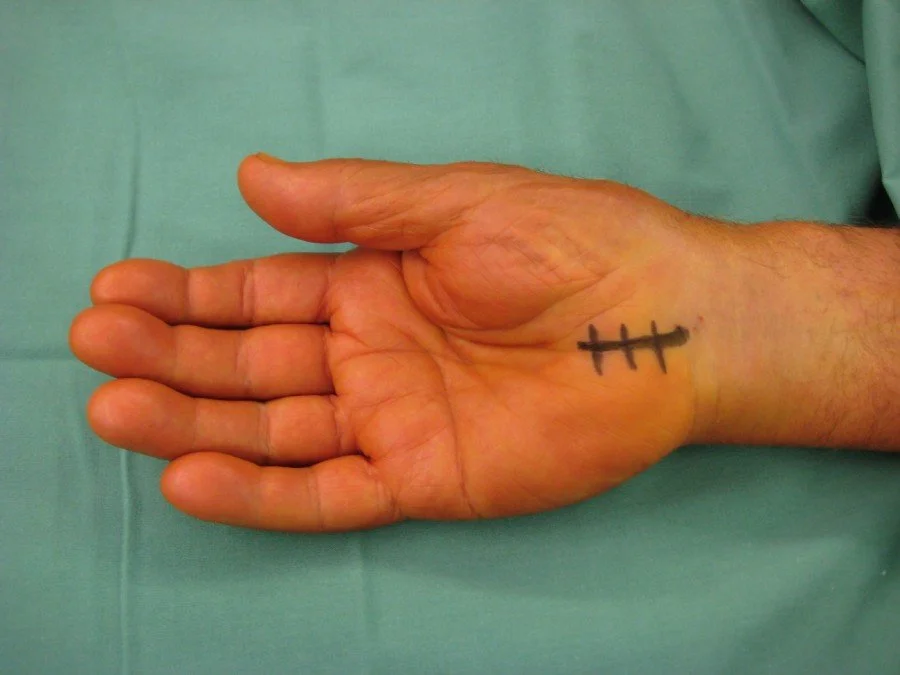 Open Carpal Tunnel Decompression (OCTD)