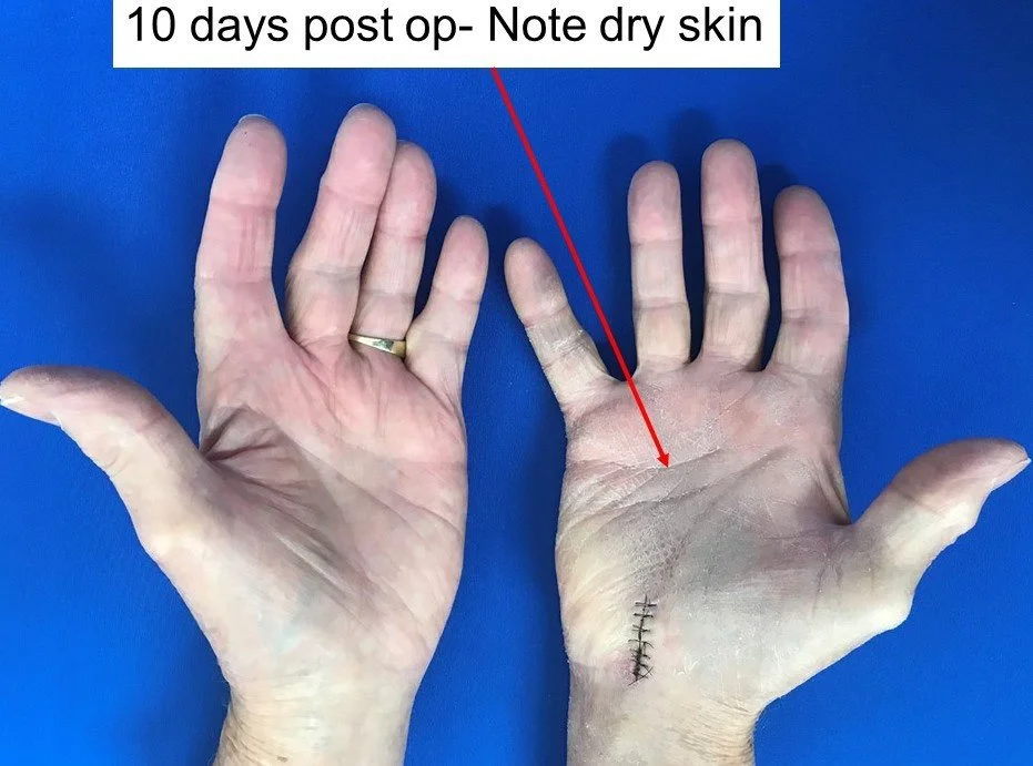 Open Carpal Tunnel - Post Op