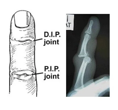 PIP Joint injuries