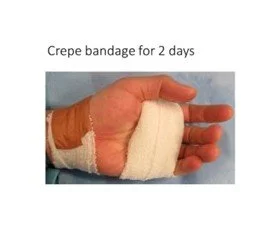 Trigger Finger - Post Op