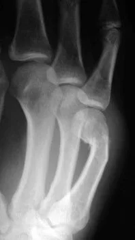 Boxers Fracture