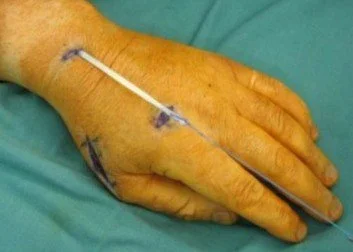 EI to EPL Tendon Transfer