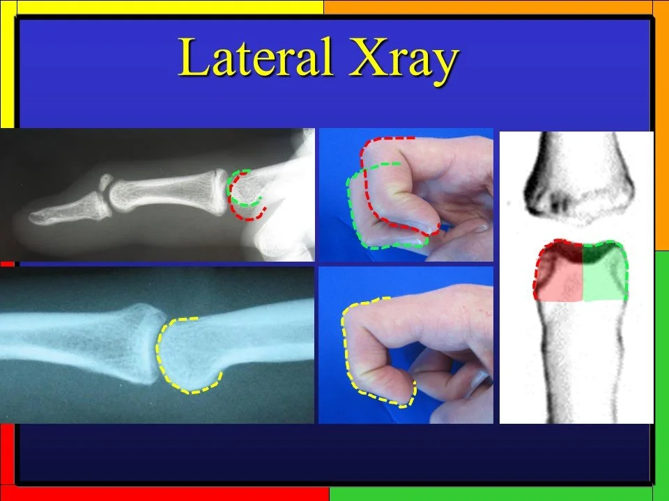 Finger Xrays