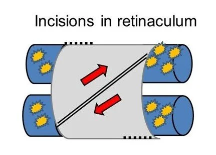 De Quervains Release