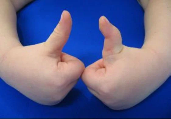 Congenital Trigger Thumb