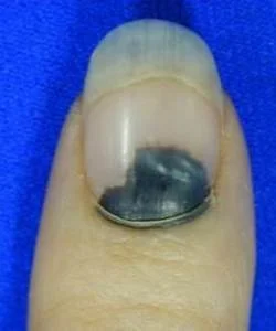 Finger Tip Injuries