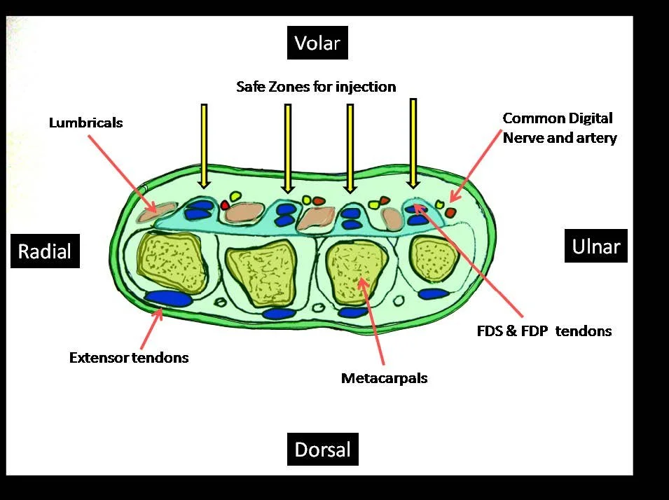 Intermetacarpal Blocks