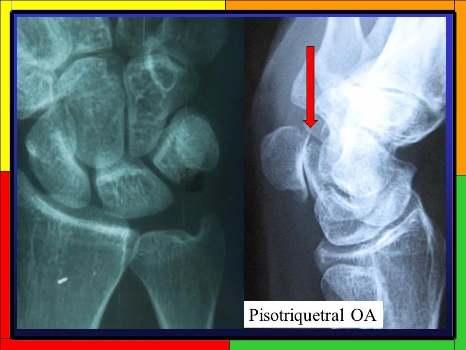 PisoTriquetral Views