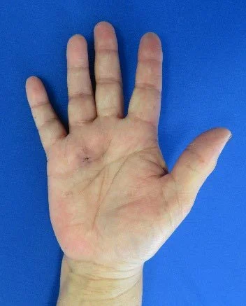 Trigger Finger - Post Op