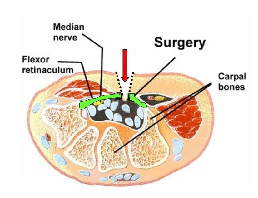 Open Carpal Tunnel Decompression