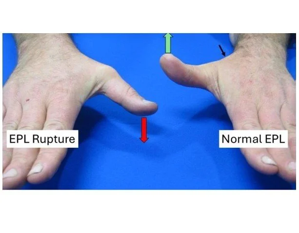 EPL Tendon Rupture