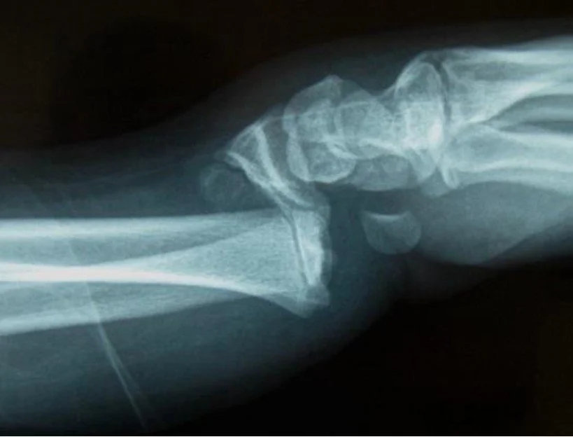 Childrens Wrist Fractures