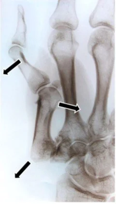 FCR Interposition Arthroplasty