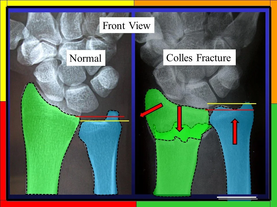 Colles Fracture Imaging