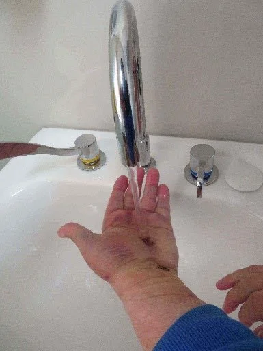 Endoscopic Carpal Tunnel - Post Op