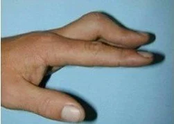 Boutonniere Deformity