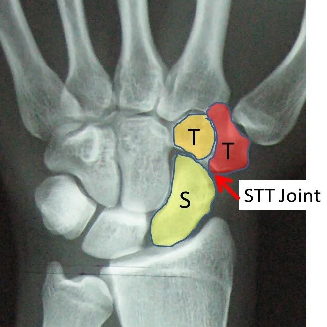 STT joint Arthritis