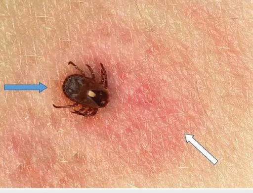 The Lone Star Tick