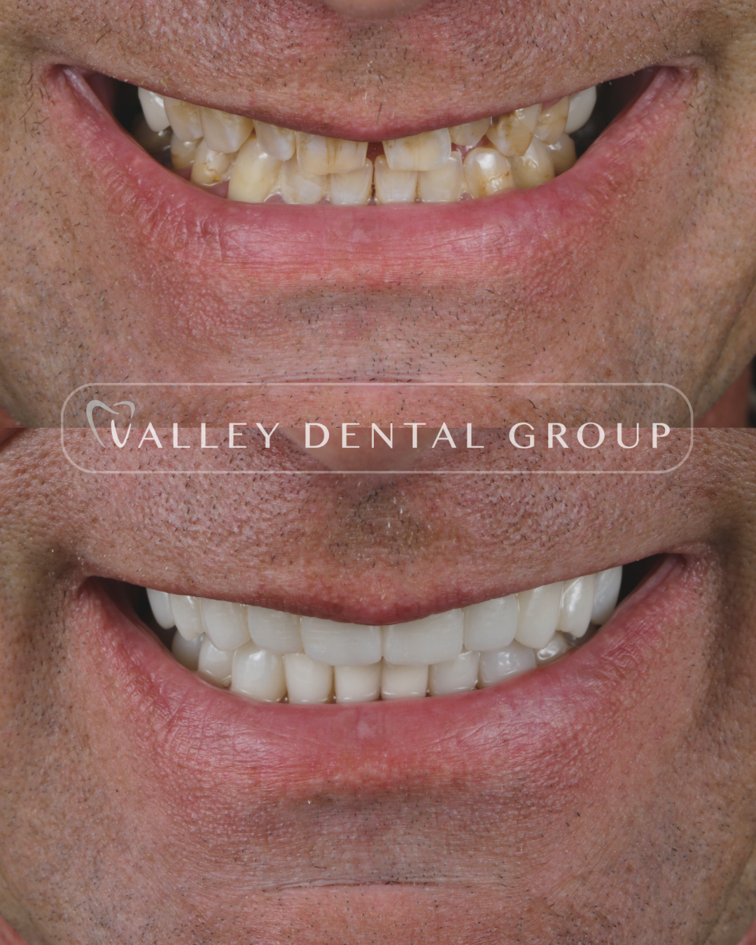 Comparison of a person's teeth before and after dental whitening, showing significant improvement in tooth color.