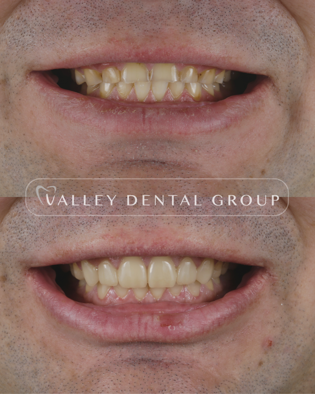 Before and after dental treatment showing improved teeth alignment and appearance.