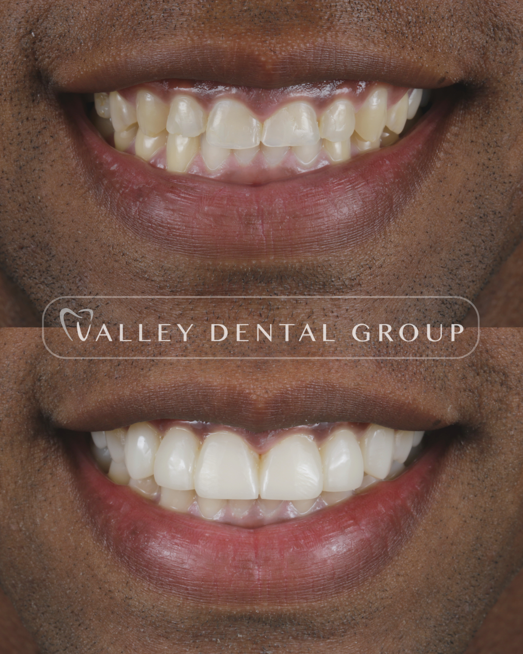 Comparison of a person's teeth before and after dental treatment, showing improved alignment and whiteness.