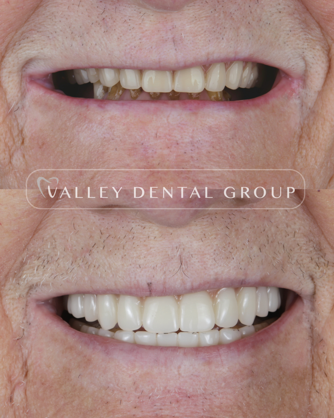 Comparison of a person's teeth before and after dental treatment, showing improved appearance of the teeth in the bottom image.