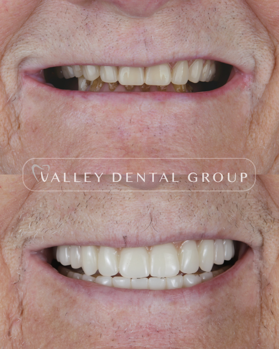 Before and after images of a person's smile showing dental restoration or whitening by Valley Dental Group.