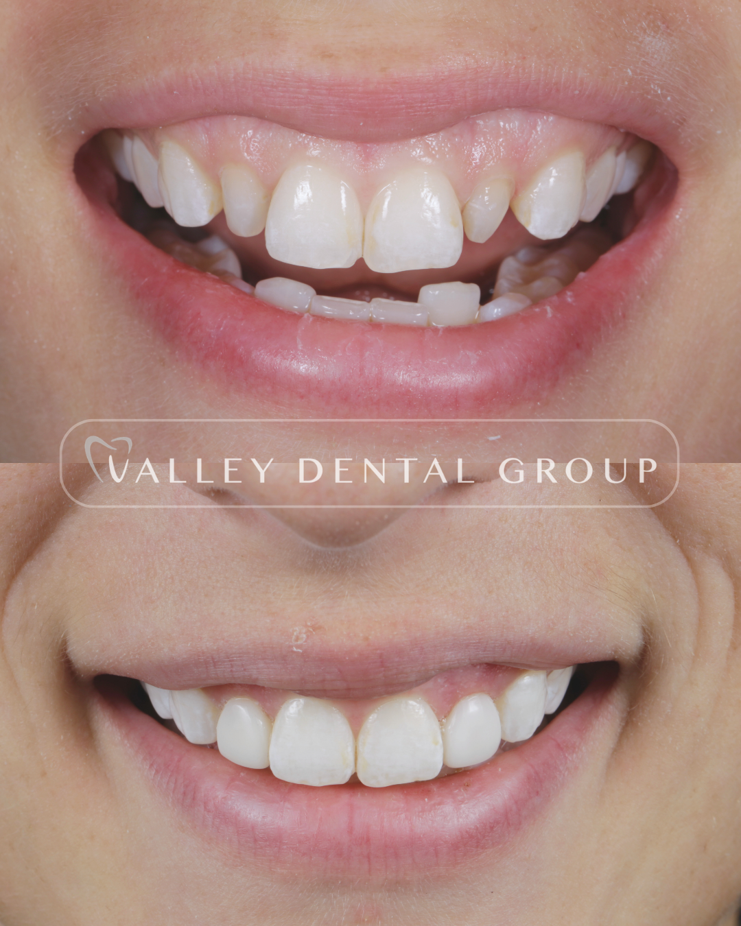A before-and-after comparison of a person's smile showing dental improvements, with the text 'Valley Dental Group' across the image.