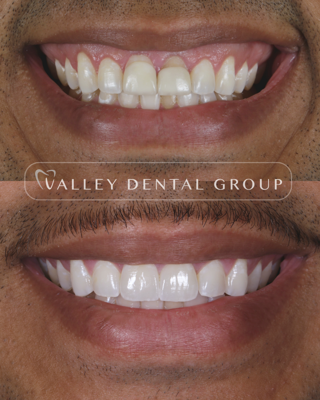Comparison of a person's teeth before and after dental treatment, showing improved dental health and alignment. Showing prosthodontics works in Phoenix, Arizona.