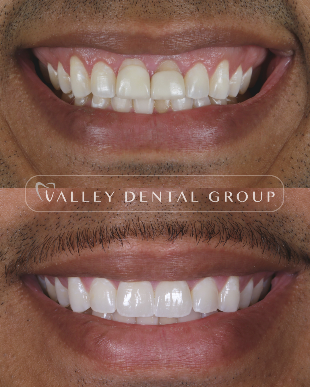 Comparison of two smiling mouths, with the top image showing teeth and gums with some crowding and unevenness, and the bottom image showing straighter, whiter teeth, both branded with Valley Dental Group.